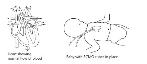 ECMO Heart & Baby